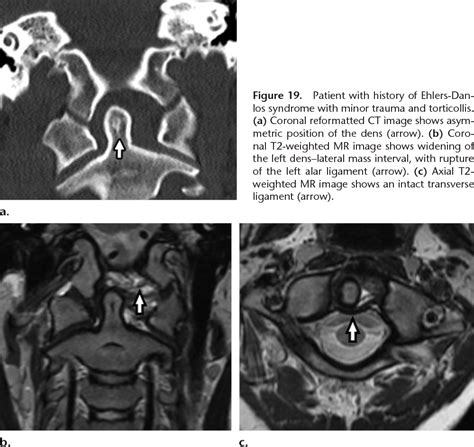 Imaging Of Atlanto Occipital And Atlantoaxial Traumatic Injuries