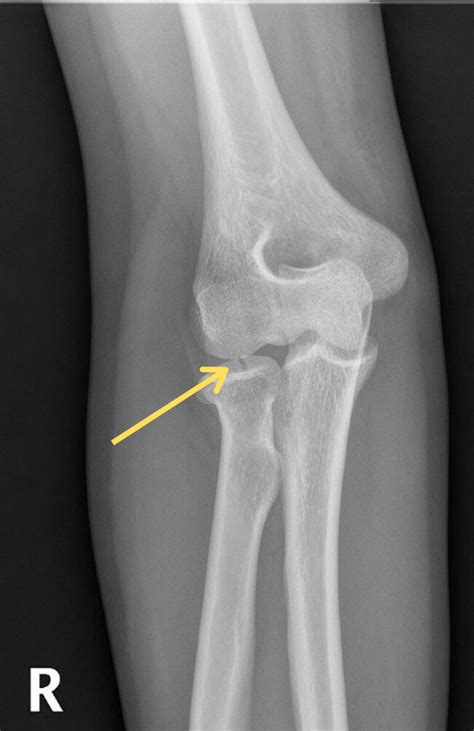 Impacted Fracture X Ray