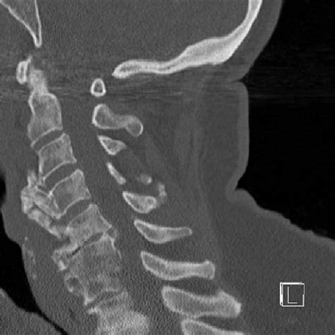 Axial Mri Of The Cervical Spine Revealed An Elongated Ossification Of