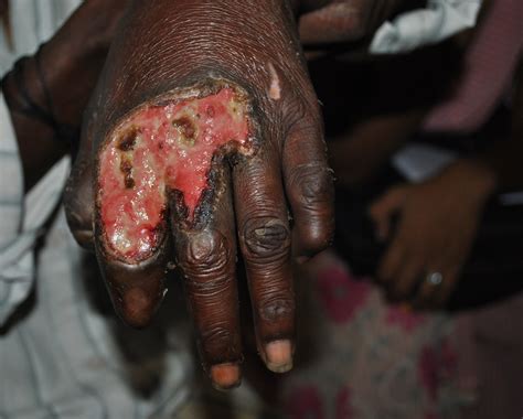 Summer in Vellore: A hands on experience with Leprosy