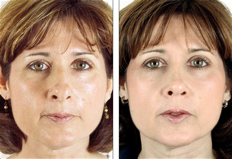 Dr Steven Denenbergs Facial Plastic Surgery Before And Afters