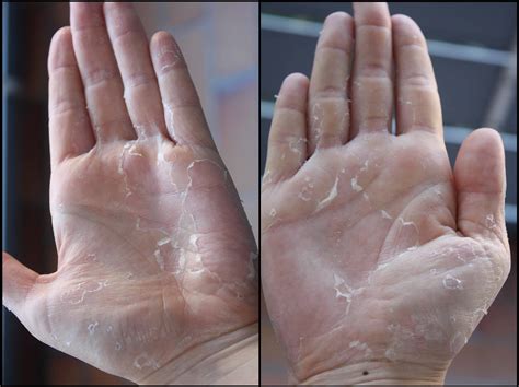 How To Get Rid Of Peeling Skin 7 Amazing Tips Ehome Remedies