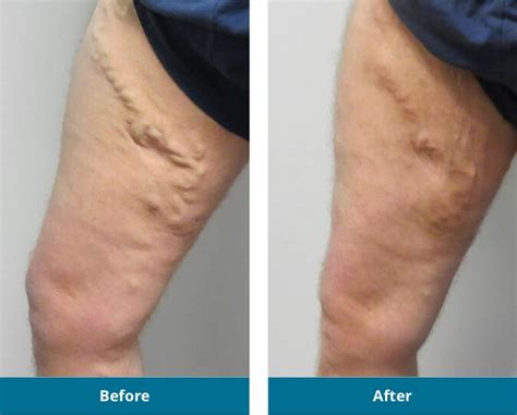 Before And After Gallery Indiana Vein Specialists