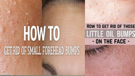 How To Get Rid Of Small Tiny Bumps On Foreheadface Simple Easy