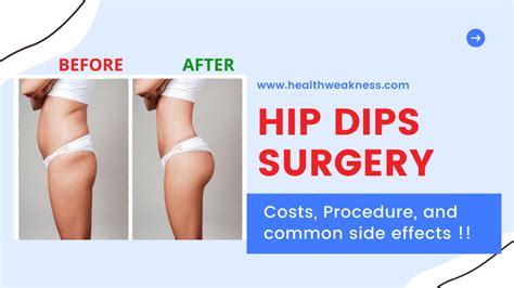 Hip Dips Surgery In 2023 Costs Procedure And Common Side Effects