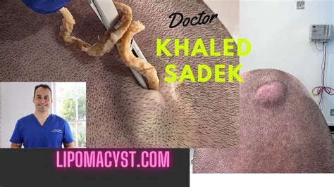 Massive Pilar Cyst Extraction With Dr Khaled Sadek Youtube