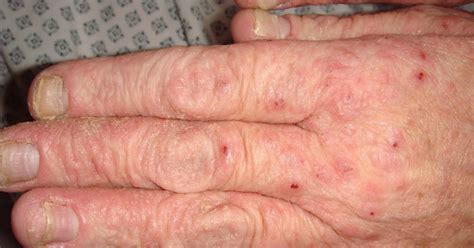 Dermoscopy Norwegian Scabies