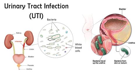 Urinary Tract Infection Uti An Overview