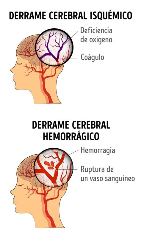 S Ntomas Para Identificar Derrames Cerebrales En Mujeres Via Ritmo