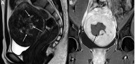 Sagittal T2 Weighted Mri A Shows The Uterine Fibroid With