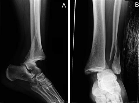 Ankle Fractures Trauma Orthobullets
