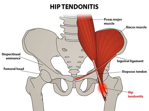 Hip Tendonitis Treatment In Nj And Nyc