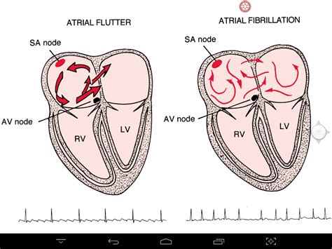 difference between typical and atypical atrial flutter multimediawas
