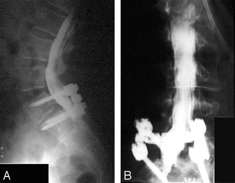 Spinal Subarachnoid Hematoma Resulting From Lumbar Myelography