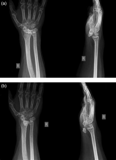 Initially Unrecognised Lunate Dislocation As A Cause Of Carpal Tunnel