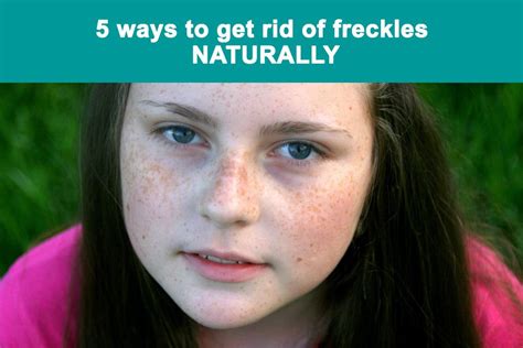 5 Ways To Get Rid Of Freckles Naturally Tip Legend Skin