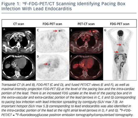 Figure 1 18f Fdg Petct Scanning Identifying Pacing Box Infection With