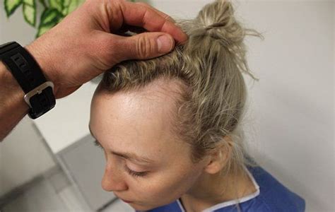 Woman Who Was Left Devastated After Going Bald At Just 20 Says That Gluing 250 Hairpieces To
