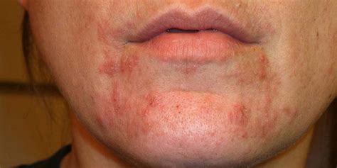5 Common Symptoms Of Staph Infection On Face Early Signs Of Staph