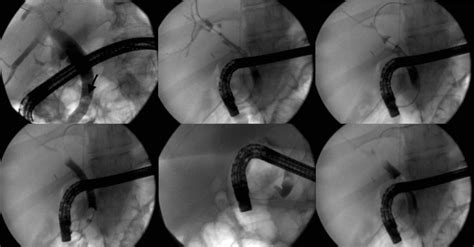 Ercp Demonstrating Balloon Sphincterotomy And Stone Removal Arrow