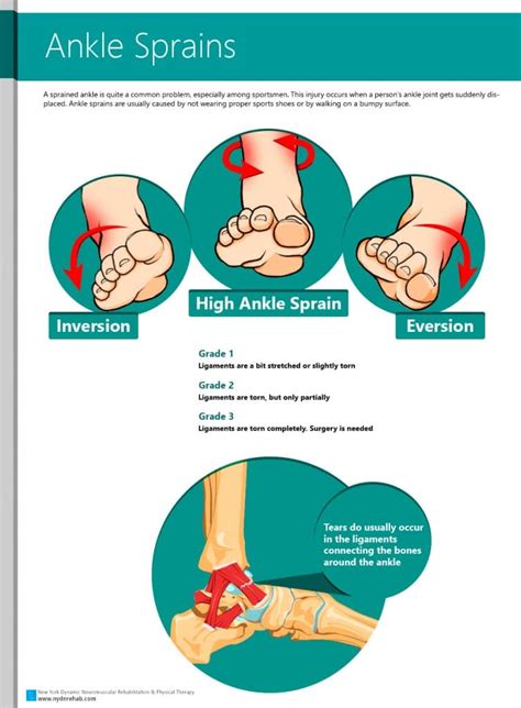 Ankle Sprains Causes And Symptoms Ankle Sprain Grades