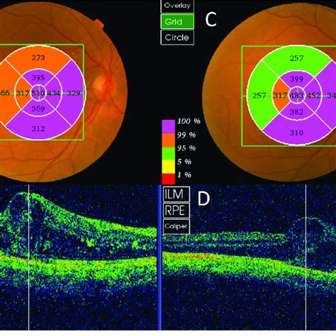 Intravitreal Bevacizumab A Preoperative Thickness Map Showing Foveal