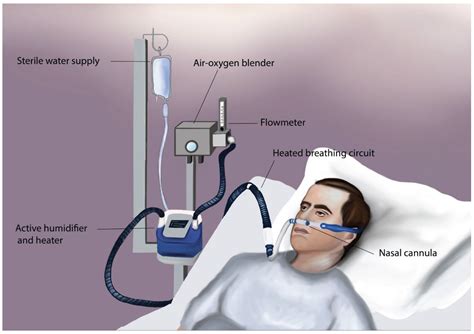 Jcm Free Full Text High Flow Oxygen Therapy In The Perioperative