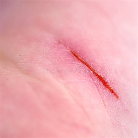 Human Skin With Wounds And Without Close Stock Photo Image Of
