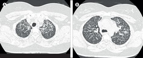 Adenocarcinoma Of Lung Presenting As Diffuse Interstitial Lung Disease
