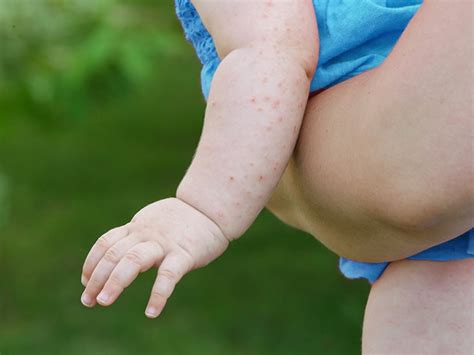 Viral Rash Baby Pictures Types And Diagnosis Medical News Today
