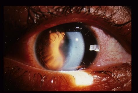 Acanthamoeba Keratitis Retina Image Bank