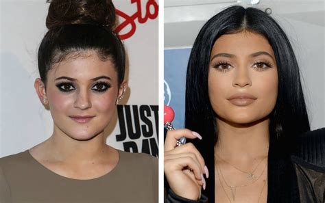 Kylie Jenner Before And After Verge Campus