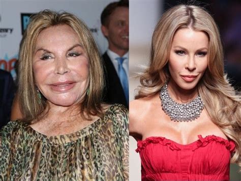Worst Cases Of Celebrity Plastic Surgery Gone Wrong Destroyed Their Looks