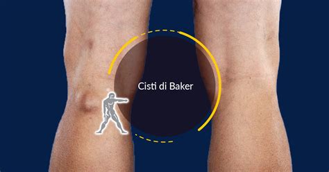 Cisti Di Baker Come Si Cura Guida Completa Ryakos Center