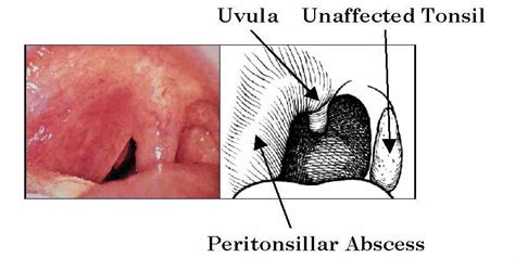 Peritonsillar Abscess Causes Symptoms Treatment Multimedia