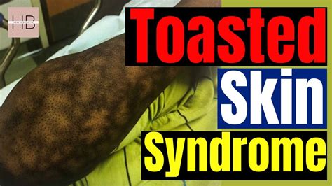 Beware You Are At Risk Of Toasted Skin Syndrome Youtube