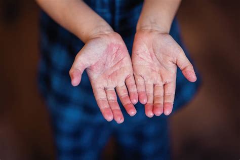 Scarlet Fever Treatment Everything You Need To Know