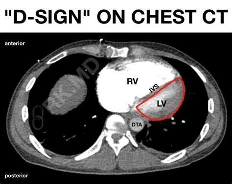 D Sign Right Ventricular Strain On Chest Ct And Echocardiography Rkmd