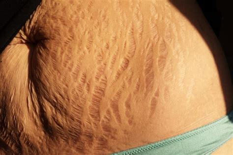 Love Your Lines Stretch Marks Go Viral In Support Of Women Deseret News