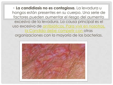 PPT Candidiasis Genital Tratamiento Cura Real Para Infecciones Por