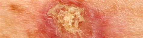 Squamous Cell Carcinoma Vitalskin Dermatology