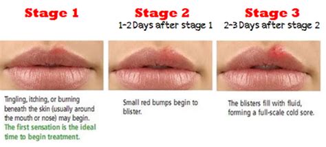 Cold Sore An Instant Treatment With Ash Natural Remedies Pocket Guide