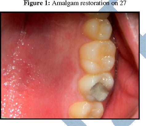 Figure 1 From Amalgam Associated Oral Lichenoid Reaction A Case