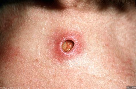 Epidermoid Cyst Infected Causes Symptoms Treatment