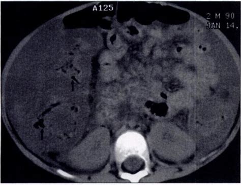 Year Old Boy With Constipation And Severe Vomiting A Ct Scan Of