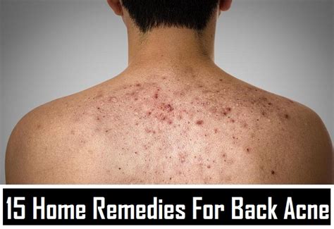Bacne 15 Home Remedies To Get Rid Of Back Acne Home Remedies Blog