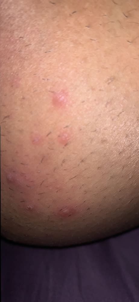 Im Scared Not Sure If This Is Herpes Folliculitis Ingrowns