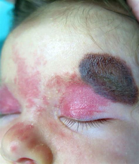 Nevus Melanocíticos Incade Clínica De Dermatología Y Láser Médico