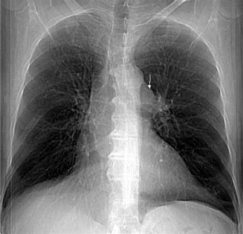 Chest X Ray Showing Enlargement Of Left Hilum Probably Due To Main