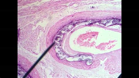 Ausência De Calcificação Patológica